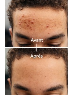 Sérum anti-acné, anti imperfection -30ml- 2