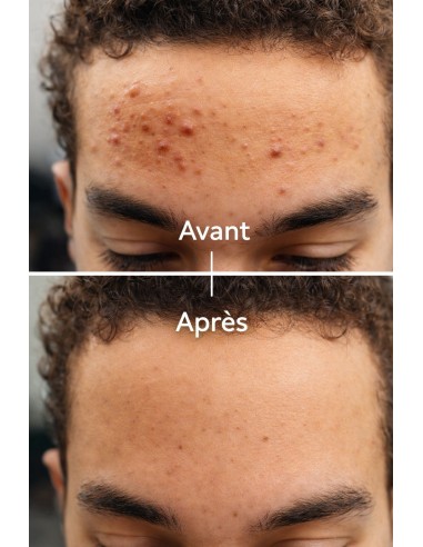 Sérum anti-acné, anti imperfection...
