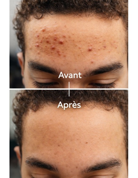 Sérum anti-acné, anti imperfection -30ml-